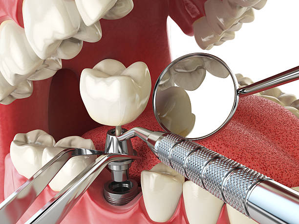 Best Emergency Root Canal Treatment in Ardmore, AL